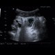 Acute appendicitis, periappendiceal infiltrate: US - Ultrasound